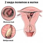 2 types of polyps in the uterus