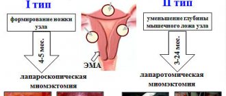 беременность после удаления миомы матки