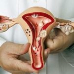 What to do after fibroid removal