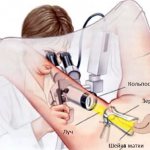 What is cervical colposcopy