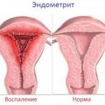 Фото: Что такое эндометрит матки