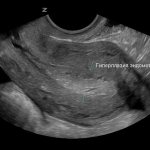 Endometrial hyperplasia on ultrasound