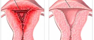Ovarian hyperplasia in menopause