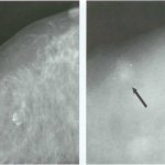 calcifications on mammography