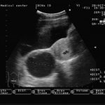Corpus luteum cyst during pregnancy, ultrasound
