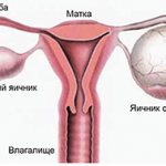 Ovarian cysts and tumors