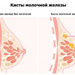 Кисты молочной железы и молочная железа без патологий