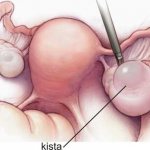Laparotomy of ovarian cyst