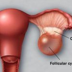 burst ovarian cyst symptoms