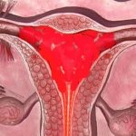 Menstruation after laparoscopy of ovarian cyst