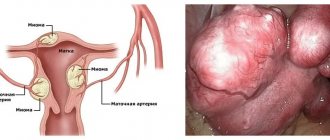 Large fibroids