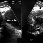 fibroids on ultrasound
