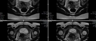 MRI of the uterus, which shows