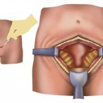 Oophorectomy (removal of appendages) in women after 40, 50, 60 years: consequences and condition of the body