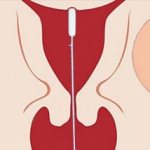 Pipelle endometrial biopsy