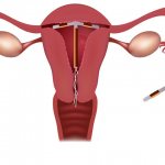 insert a uterine device
