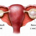 The appearance of a cyst in the ovary
