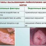 Causes of leukoplakia