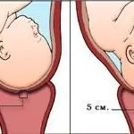 Cervix during pregnancy