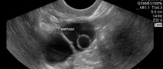 Снимок УЗИ гидатиды яичника