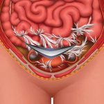 Adhesive disease is one of the most common causes of ovarian rupture