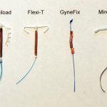 Types of intrauterine devices