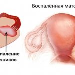 Inflammation of the ovaries and fallopian tubes